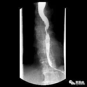 反流性食管癌晚期症状有哪些,食管癌六大症状提示已到晚期