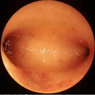 宫腔镜羊膜移植术多久能下地,重度宫腔粘连试管成功率高吗