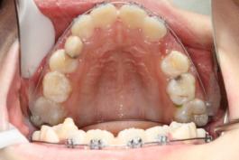 8岁的孩子能做牙齿矫正吗,7岁孩子矫正牙齿早吗