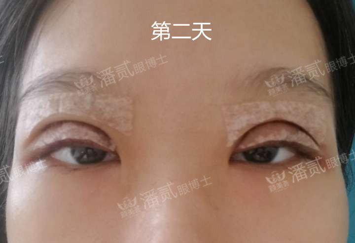 原来双眼皮不好看有必要继续割吗,割双眼皮是不是越修复越难看