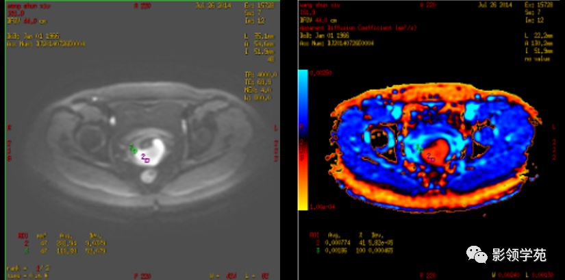 宫颈癌mri诊断,宫颈癌的mr扫描技术