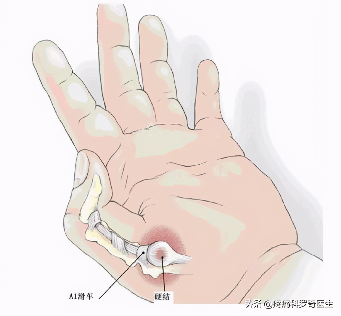 一岁半腱鞘炎最简单自愈方法,腱鞘炎小妙招一招摆脱困扰