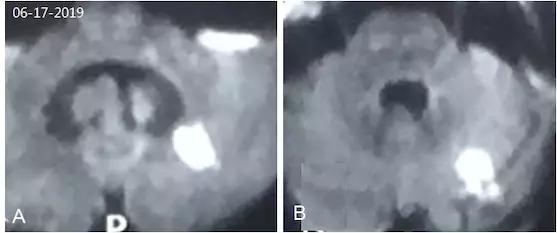 基底动脉狭窄介入指南,基底动脉重度狭窄用药用量