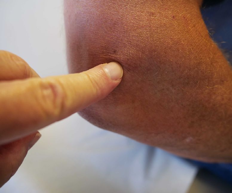 肱骨外上髁炎网球肘最快治疗方法,肘关节外侧按压疼痛的原因