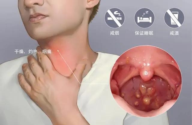 顽固性咽炎最佳治疗方法,治慢性咽炎最快的土方