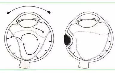 眼前一直有蚊子是什么病,眼前总有蚊子飞怎么治呀