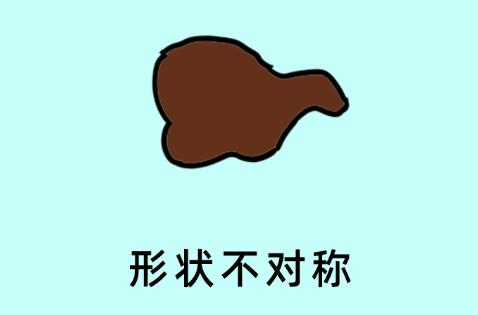 科普一颗平淡无奇的痣竟然会癌变,痣癌变的信号有哪些