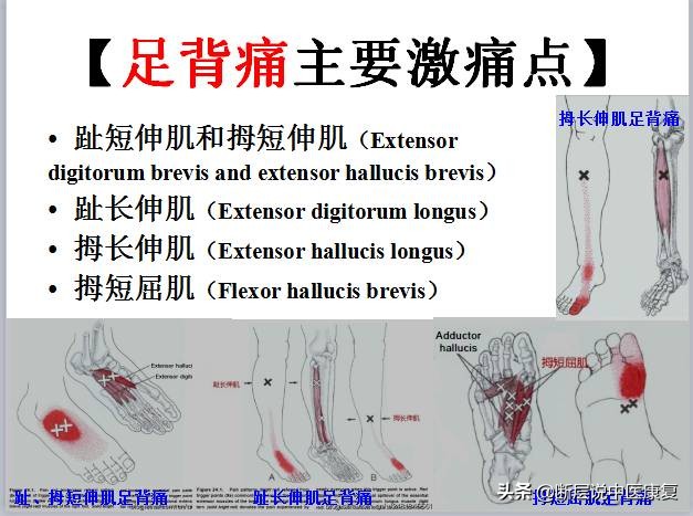 激痛点挂图,激痛点疗法笔记