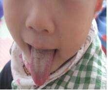 孩子体内有积滞和湿热怎么办,小孩体内热怎么调理最快