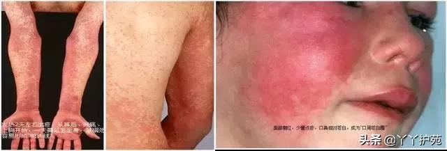 儿科常见出疹性疾病,儿科常见出疹性疾病有哪些