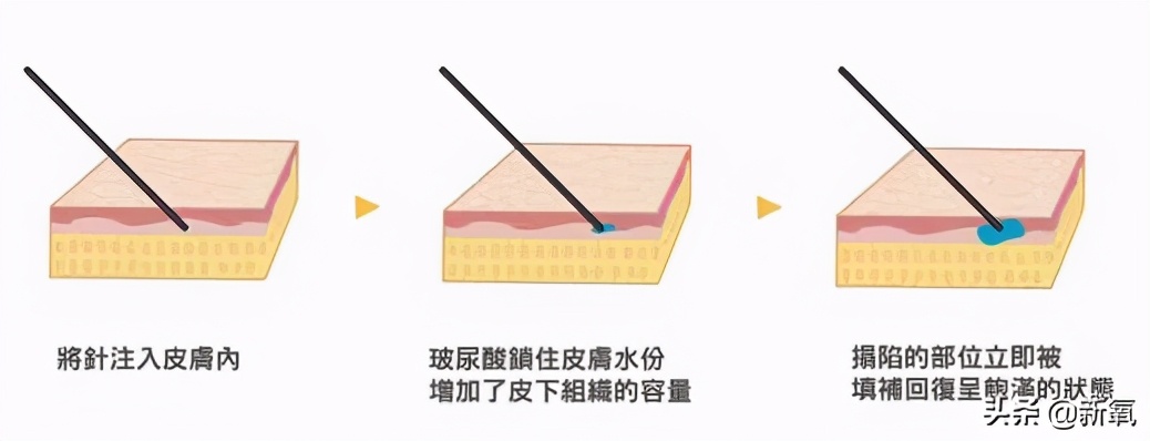 戴牙套真的会出现牙套脸,戴牙套期间牙齿变龅了