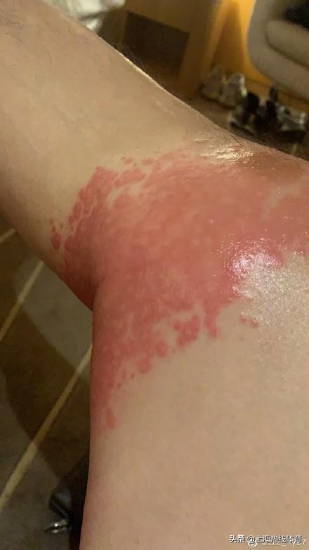 队医给国奥门将推荐遗精药致膝盖过敏