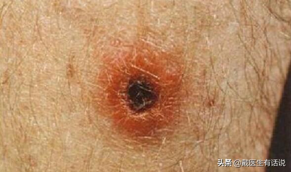 春季常见虫咬,虫咬有什么严重后果