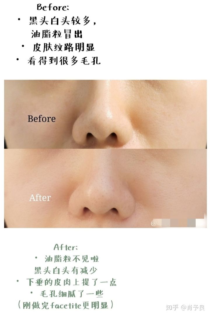 祛黑头清理过程,怎样可以祛黑头收缩毛孔