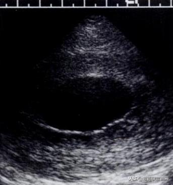 3毫米卵黄囊未见胎芽正常么,40多天的卵黄囊