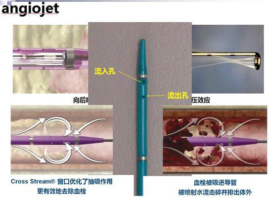 两个针眼便能吸出大腿静脉血栓哈医大一院开展静脉血栓吸除术已成功治愈近200名患者