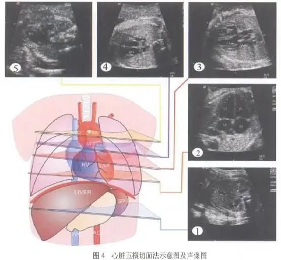 干货分享丨胎儿心脏畸形产前超声筛查与诊断策略