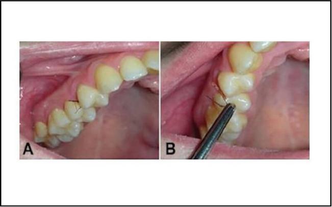 一女子患上罕见牙龈多毛症，牙齿里竟然长出了毛发