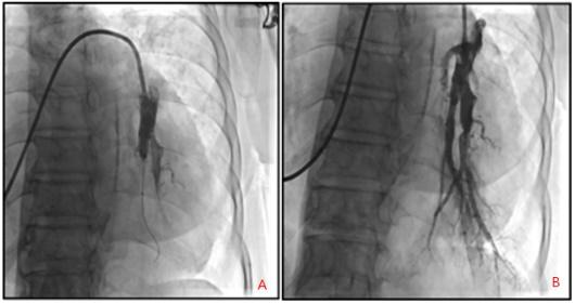 血栓高血压的症状和治疗,慢性肺血栓栓塞性肺动脉高压预后