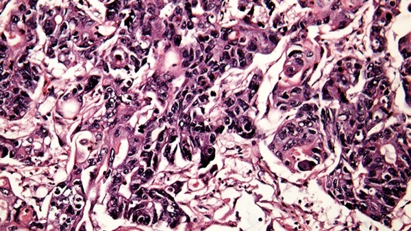 专家提醒小心梅毒引发的多重危害,隐性梅毒的传染性强吗