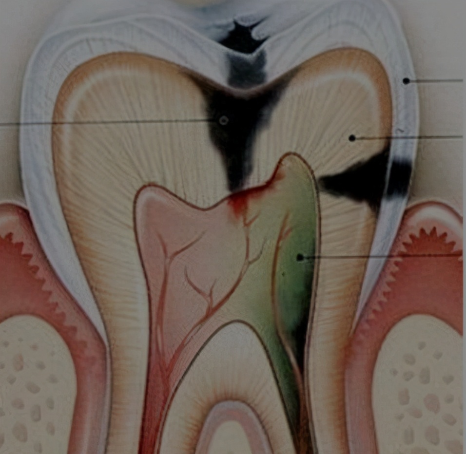 根管治疗封药后一碰疼痛,牙齿根管治疗封药后疼痛怎么办