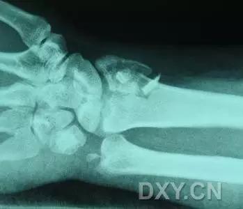 所有骨折都叫什么名字,骨折的名称有哪些