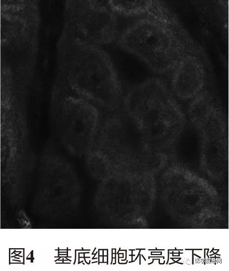 炎症性皮肤病反射式共聚焦显微镜诊断特征专家共识全文发布