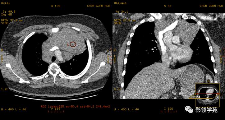 纵隔和肾上腺恶性肿瘤,纵隔性肿瘤位置图