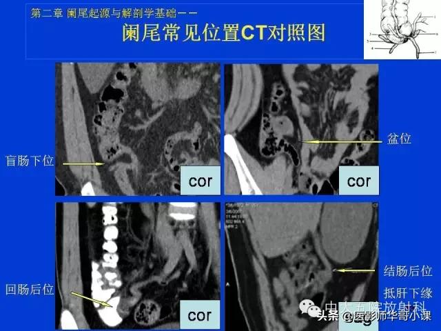 阑尾炎课件,阑尾炎的超声课件