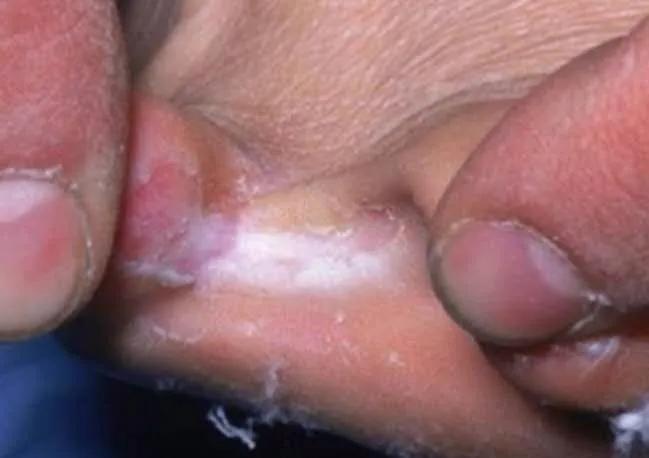 冀连梅治脚气最佳方法,用这个小方法彻底根治脚气