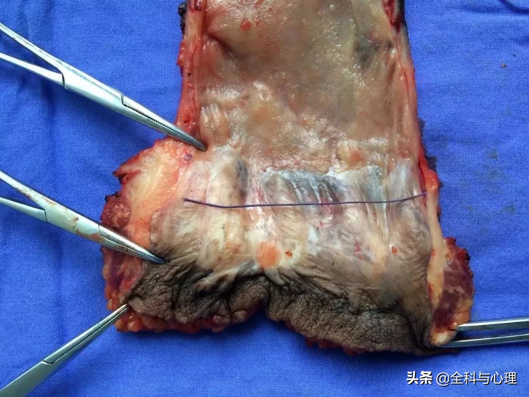 肛门突然有肿块怎么治疗最好,肛门里面有肿物有什么症状