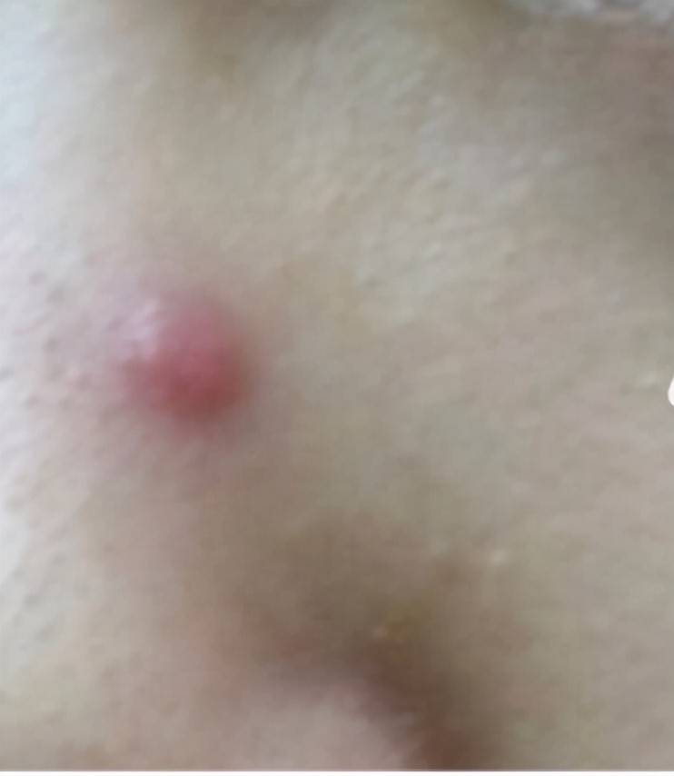 挤痘是正确的吗,关于挤痘痘的几点忠告