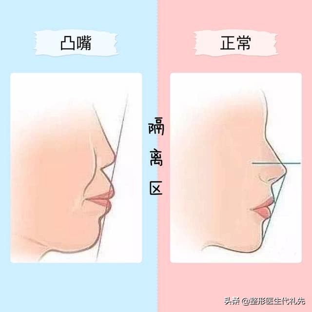 从整形医生的角度来聊一聊形成法令纹的原因以及改善方案