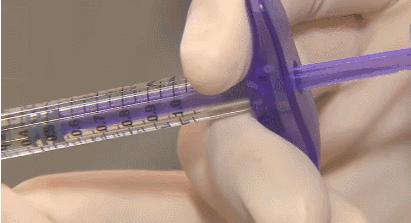 法令纹最新整形消除法,怎样医疗美容去除法令纹