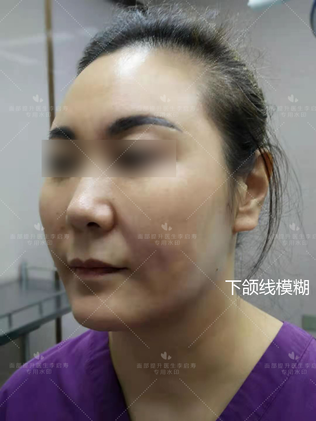 40岁做了线雕的前后图片,40岁以上法令纹下垂医美