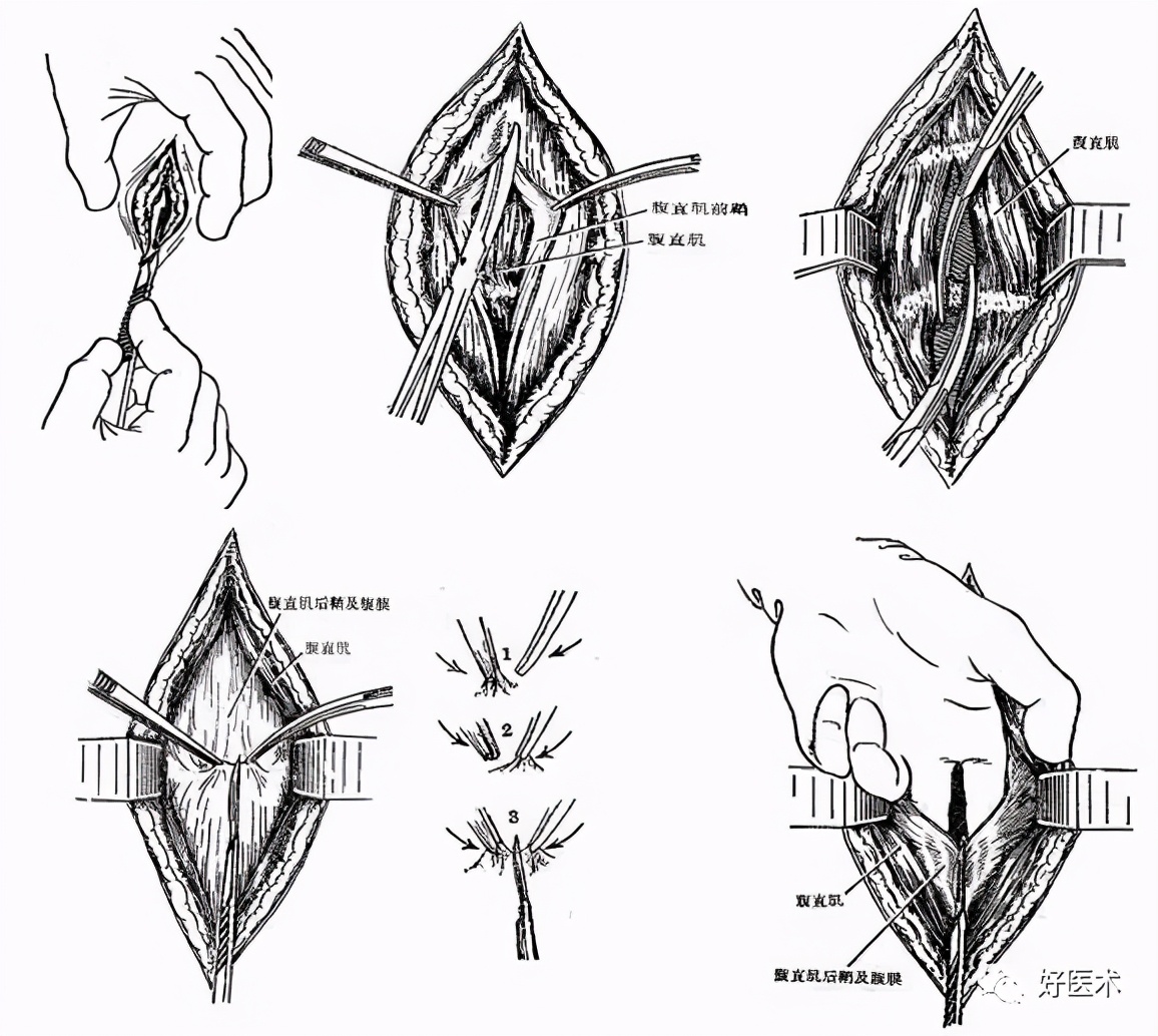 气管切开注意事项,切开引流注意事项