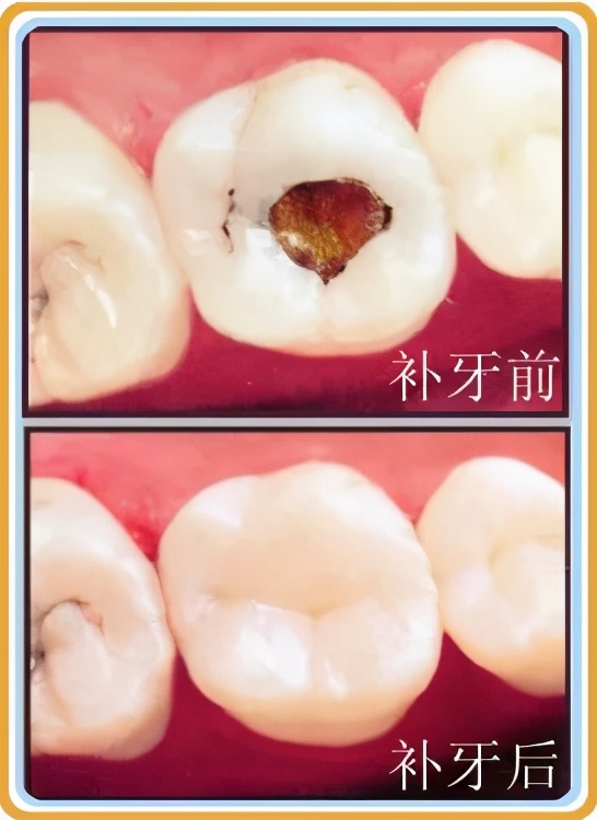 牙齿受外力横向断裂怎么办,牙齿意外脱落如何处理