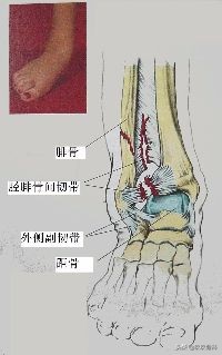 陈旧性踝关节损伤的治疗,踝关节损伤现场处理视频