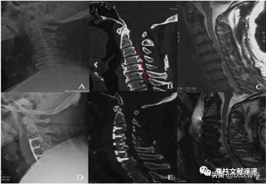 acaf手术适应脊髓型颈椎病吗,acaf术后康复方法