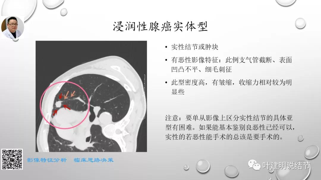 叶建明谈肺实性小结节视频,廖正银教授谈肺结节