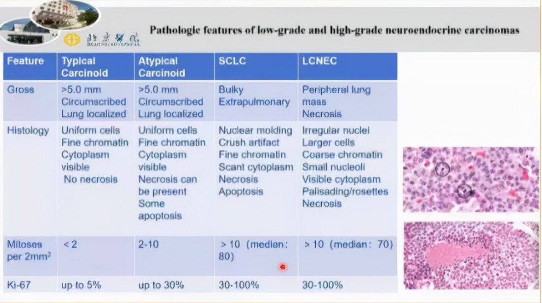 治疗后体温恢复,症状、影像仍进展,证据指向的感染竟只是迷障?