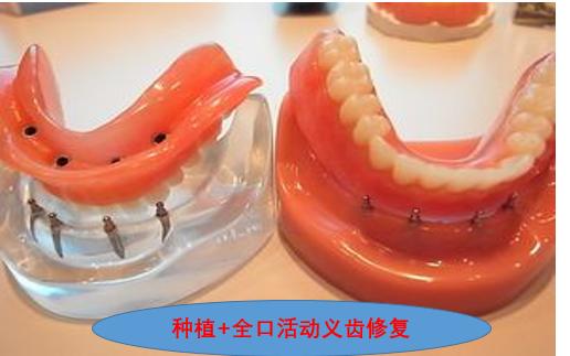 全口牙缺失对外貌的影响,牙齿缺失十几年咀嚼功能如何恢复