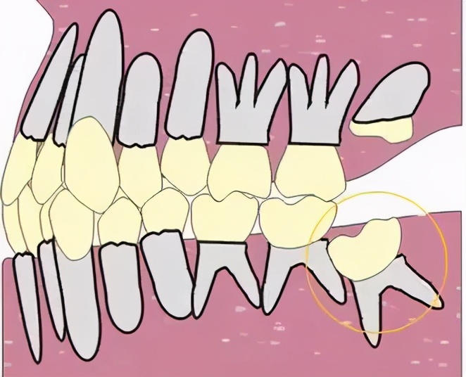 牙齿矫正的九大常见误区,牙齿矫正之七大误区