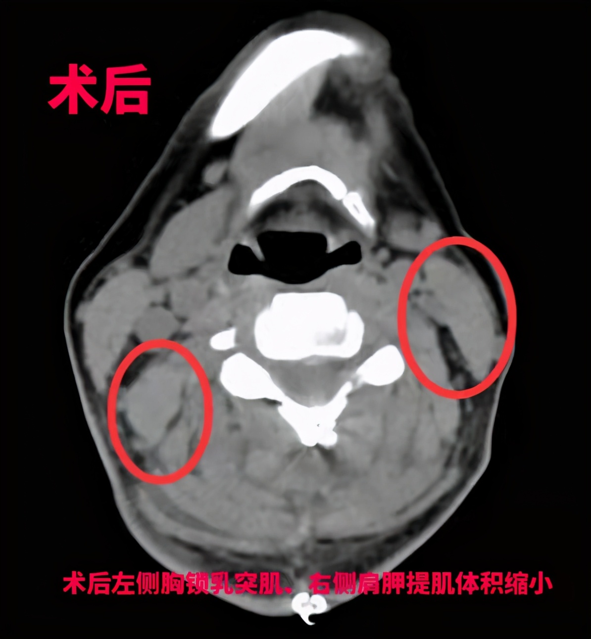 矫正脖子歪的手术是怎样的,治疗歪颈视频