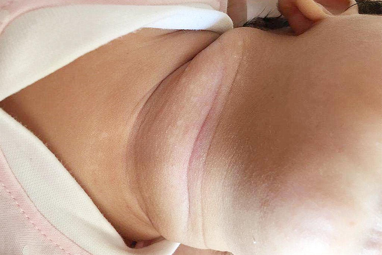 宝宝淹脖子妈妈饮食应该注意什么,宝宝淹脖子怎么护理