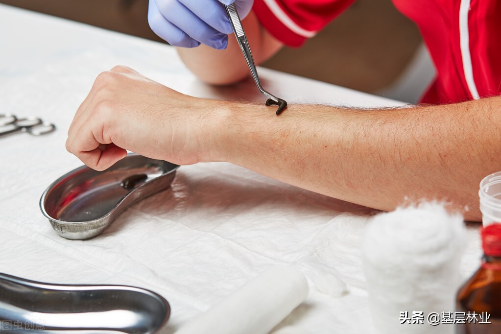 山蚂蝗咬过之后伤口很痒怎么医治,山蚂蝗咬了用什么药好