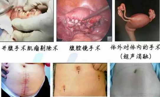 子宫肌瘤开腹手术是大手术吗,子宫肌瘤手术大概需要多少钱