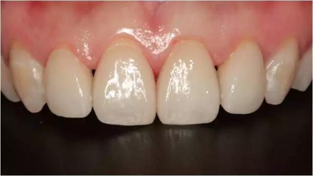 四十多岁门牙缝隙越来越大怎么办,儿童门牙缝隙越来越大原因