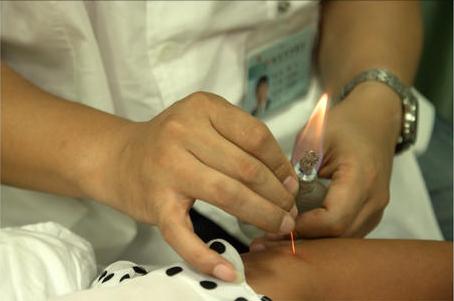 针灸治疗的效果令国外惊叹视频,贺氏三通针灸视频教程