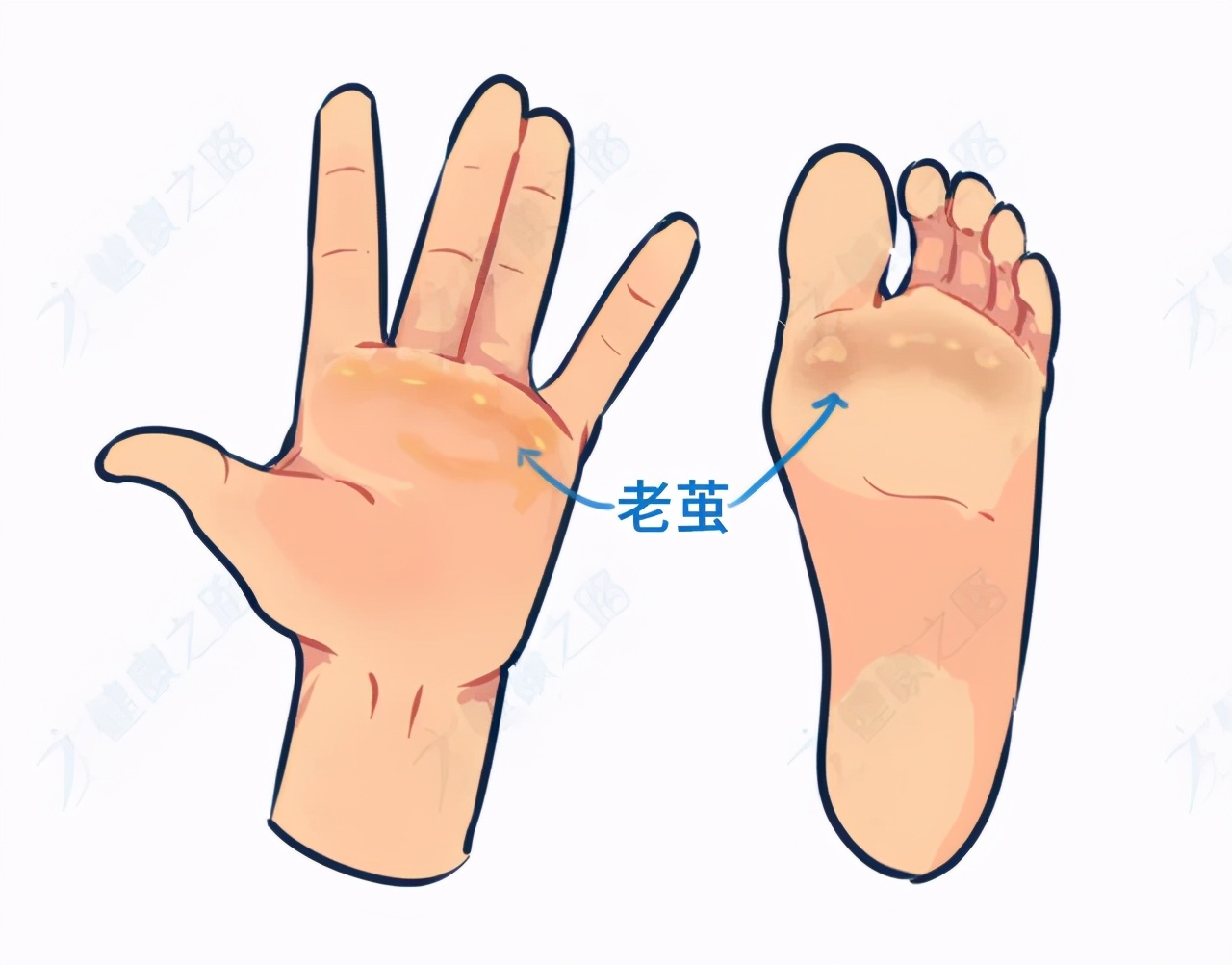 脚底长鸡眼一招搞定,脚底长鸡眼怎么治好了又复发